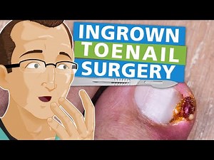 Ingrown Toenail Surgery
