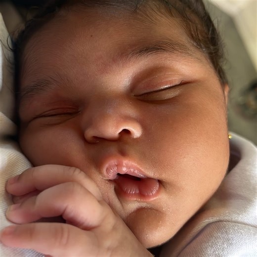 It's called ENCEPHALOCELE Is a neural tube defect characterized by sac-like protrusions of the brain and the membranes that cover it through openings in the skull. These defects are caused by failure of the neural tube to close completely during fetal development. It can happens in frontal (fore head) or at the back. Those babies with it in front of their head has a better chance of survival, While Babies with an encephalocele at the back of the head (like this baby) have a 55% percent survival