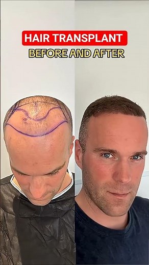 Hair Transplant Turkey Before and After #hairtransplantturkey #hairtransplant