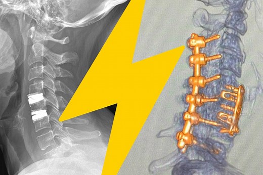 Artificial Disc Replacement vs Spinal Fusion | VSI®