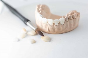 Best Materials and Preparation Designs for Dental Veneers