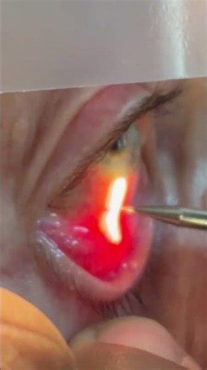 plasma pen to treat conjunctivochalasis. IMG 9889