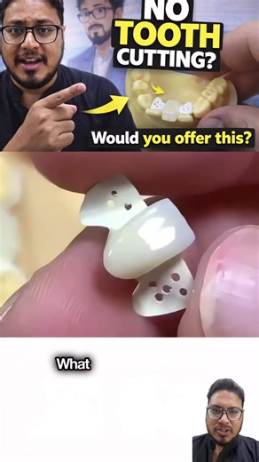 Dr Chandra Mohan | Invisalign | Hyderabad🇮🇳 on Instagram: "Resin Adhesive Bridge: A Conservative Dental Restoration Solution 🦷✨ A resin adhesive bridge (often called a Maryland bridge) is a minimally invasive way to replace a missing tooth—especially popular when preserving natural tooth structure is a priority. What Is It? 🤔 It’s a fixed dental bridge that uses resin cement to bond a replacement tooth to the back of neighboring teeth. Unlike traditional bridges, it usually doesn’t require m