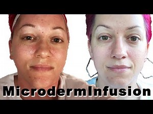 Microderm Infusion Facial | Informative Video