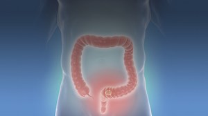 Colon Cancer: Pros & Cons of Screening Younger Patients