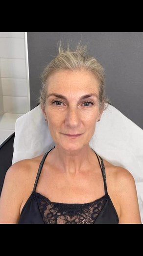 7.5K views · 16 reactions | ✨ Anti-Wrinkle Treatment: Before & After...
