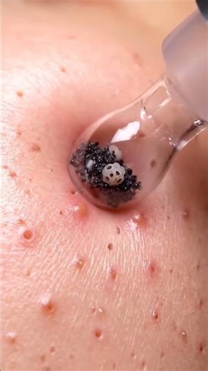 Deep Blackhead Extraction — No Talking