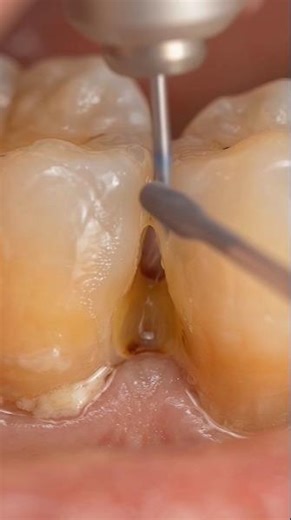 Tartar Bridge Build-Up – Hardened calculus connecting adjacent teeth #dentist #toothcrown#teethcare