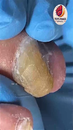 8K views · 81 reactions | Proven Steps to Help Parents Avoid Expensive Treatments  #SafeSteps #DiabeticFootCare #FootSupport | Tots Mags Wheel | Facebook