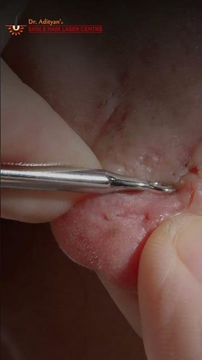 Earlobe Keloid Explained: Causes, Prevention & Treatment Options