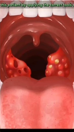 Satisfying Tonsil Stone Removal!