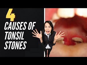 4 Causes Of Tonsil Stones
