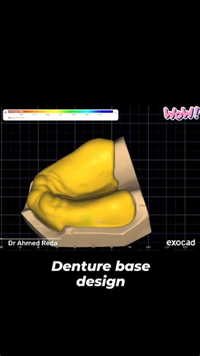 Denture base design on exocad. #exocad #digital_dentistry #dsd #dentistry | Ahmed Reda