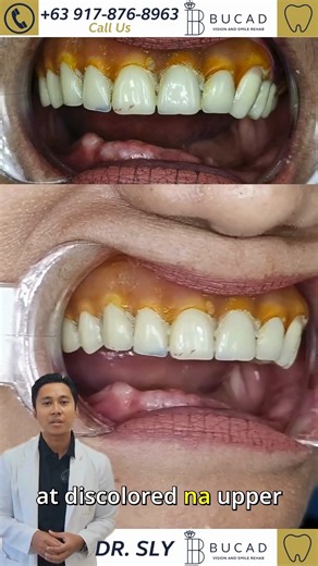 9.8K views · 100 reactions | Denture and Bridge Replacement...