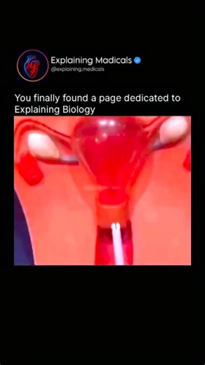 Medical | Health | Anatomy on Instagram: "This Is How an IUD Is Inserted Into the Uterus An intrauterine device (IUD) is inserted during a brief medical procedure performed by a trained healthcare provider. First, a speculum is placed in the vagina to gently open it and allow the cervix to be seen. The cervix and surrounding area are cleaned to reduce the risk of infection. The provider then measures the depth of the uterus using a thin instrument to ensure correct placement. The IUD, which is f