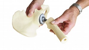 Ask the Doctors: Hip resurfacing an alternative to hip-replacement surgery