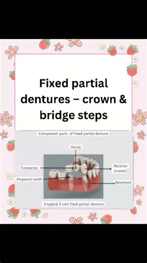 Dr priyanka on Instagram: "Fixed Partial Denture (FPD) – Crown & Bridge Steps 1. Diagnosis & Treatment Planning ●Thorough case evaluation: medical history, periodontal condition, caries status, occlusion. ●Assess abutment teeth for crown-root ratio, vitality, and alignment. ●Radiographs are essential to evaluate bone support. (Exam Tip: Abutment selection is the most important step — failure here affects the whole prosthesis.) 2. Tooth Preparation ●Aim: To provide retention, resistance, and esth