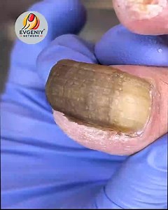 19K views · 136 reactions | Preventive US Healthcare Tips for Foot and Nail Support#WellnessSeniors #FootSupport #SafeSteps | Evgeniy | Facebook