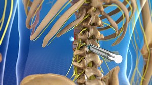Sympathetic Nerve Block - Sound Pain Alliance - Our Treatments