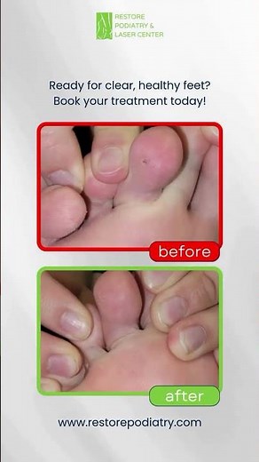 Plantar Warts | Laser Treatment | Non-Invasive | Best Solution