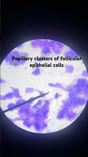 #papillary carcinoma thyroid cytology #cytology #Pathology
