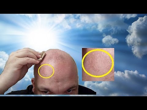 How to Remove SUN Spots Natural Home Remedy (Skin Damage Fade Liver Brown Freckles Age Cure Heal Sol