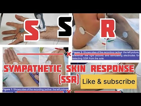 SSR (sympathatic skin responce) | galvanic response #neurotech #NCS #emg