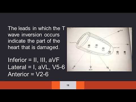 12. The T wave abnormalities