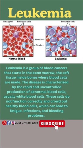 Leukemia|White Blood Cell Cancer|Abnormal Production of Leukocytes #leukemia #bloodcancer #ytshorts