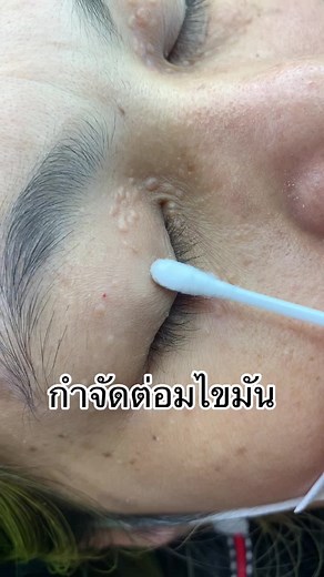 Removing Blackheads Around the Eyes: Beauty Treatment Tips