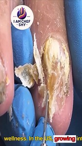 Professional Nail Advice for Overgrown Toenails Without Cutting or Filing #ToenailSupport #NailFixTips #ThickToenailCare #HomeNailCare | I am Chef Shy