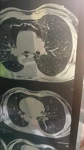 subcutaneous emphysema with pneumomediastinum