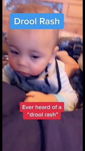 How to Treat Baby Drool Rash: Tips for Moms