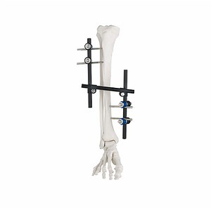 [Hot Item] Adjustable External Fixator for Tibia Fracture - Orthopedic Implant & Surgical Instrument