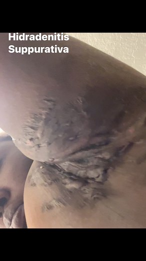 87K views · 123 reactions | When you are flared up what do you use to manage the pain? I know many of us haven’t found anything that helps. But if you have what’s your secret. For many I’ve heard multiple treatment options. #yourfavoriteshooter #HidradenitisSuppurativa #vlog #hidradenitissuppurativaawareness #contentcreator #abscess #flareup #disability | Destineé Spruell | Facebook