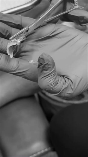 Nail Avulsion Procedure | Removing a Damaged Toenail Safely