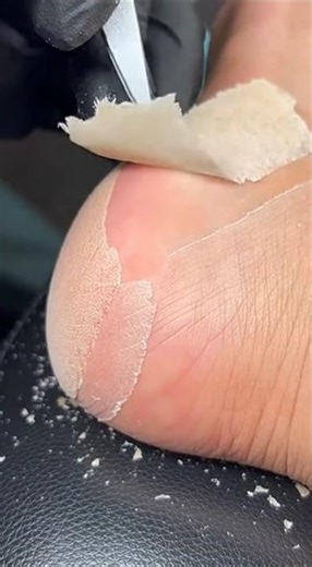 CENTRAL HEEL PEEL | Surgical-Level Removal of a Massive Dead Skin Sheet | 4K Macro Foot Care
