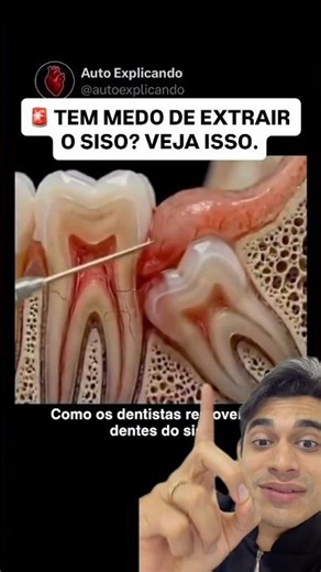 Are you afraid of having your wisdom teeth extracted? See what really happens 😳🦷 #oralhealth #sho...