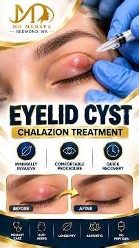 Eyelid Cyst (Chalazion) Treatment | Redmond WA MedSpa
