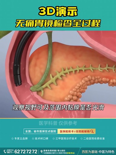 无痛胃镜检查全过程演示