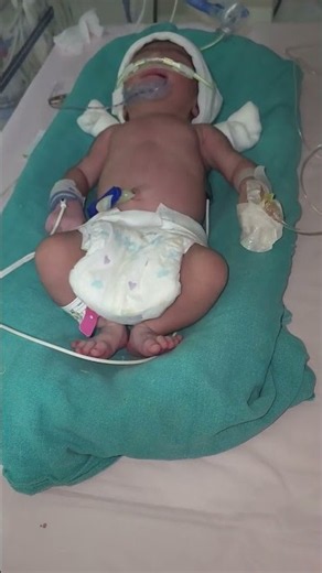 Respiratory Distress in the newborn l RDS in newborn ‪@Newborns1808‬ #newborn #cutebaby