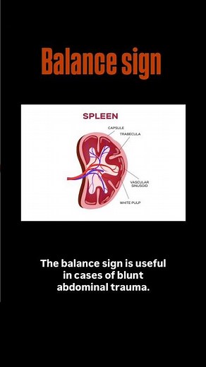 Splenic rupture..? #spleen #abdomen #bleeding #hemorrhage #surgeon #surgery #doctor #blood #injury