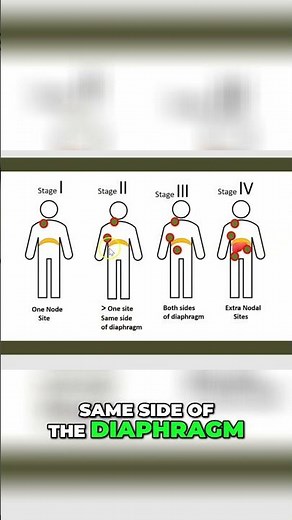 Lung Cancer Stages Explained: A Comprehensive Guide #shorts