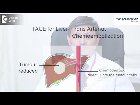 TACE For Liver Cancer? - Dr. Ravichand - Liver Transplant Surgeon in Bangalore - Manipal Hospitals