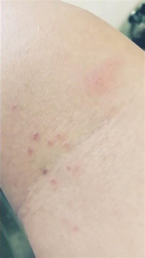 i think spider bit me