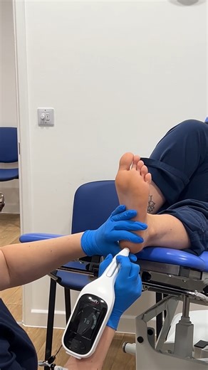 🌿 Still struggling with a verruca that just won’t budge? Meet Swift Pro - the smarter way to treat them. 👣 At SW Podiatry, we’re proud to offer Swift Pro, a cutting-edge verruca treatment that uses microwave technology to target the infection precisely and effectively. Here’s how it works: ⚡ The Swift Pro device delivers controlled microwave energy through the skin directly into the infected tissue. 🔥 This energy causes a quick burst of heat, which stimulates your body’s natural immune respon