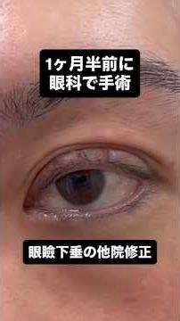 他院術後1ヶ月半の修正手術 #眼瞼下垂 #他院修正