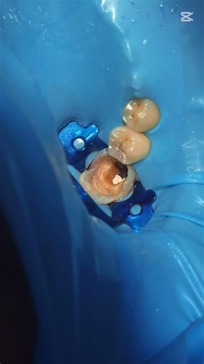Molar Rebuild 🔥