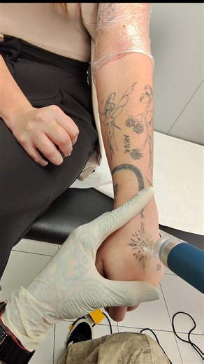Chong on Instagram: "Láser en la mano ✋ En esta zona el tatuaje suele eliminarse antes gracias a la mayor circulación sanguínea. Ornamental negro respondiendo muy bien desde las primeras sesiones. Cada cuerpo y zona cuenta. Guarda el vídeo y si quieres borrar el tuyo, escríbeme. #lasertattoo #eliminaciondetatuajes #lasergirona #tattooremoval #laserremoval"