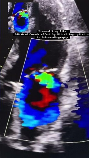 “Diamond Ring like “, 360 Grad Coanda effect by Mitral Regurgitation in echocardiography